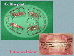 Lingual Orthodontics